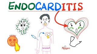 Infective Endocarditis - Fever & New Murmur - Modified Duke’s Criteria - Cardiology Playlist