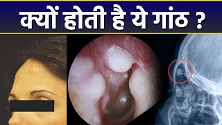 सिर पर उभरी हुई हड्डी या गांठ क्या होती है । ऑस्टियोमा होने का कारण | Osteoma | Boldsky *Health