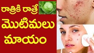 రాత్రికి రాత్రే మీ మొటిమలు మాయం || Remove Pimples/Acne Naturally Overnight | Gold Star Entertainment