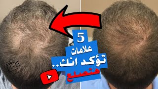 بداية الصلع الوراثي | 5 علامات لو بيحصلك 3 بس منهم يبقى عندك صلع وراثي | الحق نفسك