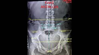 Gonstead Chiropractor Gets Hurt - Before After X-rays, Fake Antalgic X-ray Comparison