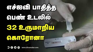 எச்ஐவி பாதித்த  பெண் உடலில்  32 உருமாறிய  கொரோனா