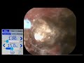 role of 60 watts holmium and tfl in the same case of rirs for large volume stone inferior calyx