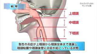 急性咽頭炎／ミルメディカル　家庭の医学 動画版