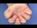 ulnar dimelia understanding mirror hand syndrome