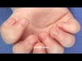 ulnar dimelia understanding mirror hand syndrome