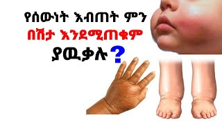 የሰውነት እብጠት ምን በሽታ እንደሚጠቁም ያውቃሉ?