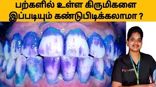 பற்களில் உள்ள கிருமிகளை கண்டு பிடிக்க எளிய வழி? plaque / disclosing tablet  - how to use in Tamil