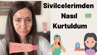 SİVİLCELERİMDEN NASIL KURTULDUM | Sivilce ve siyah noktalara kalıcı çözüm #part1