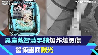 男童戴智慧手錶爆炸2度燒燙傷　驚悚畫面曝光│94看新聞