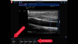 Cardiovascular Suite - IMT analysis
