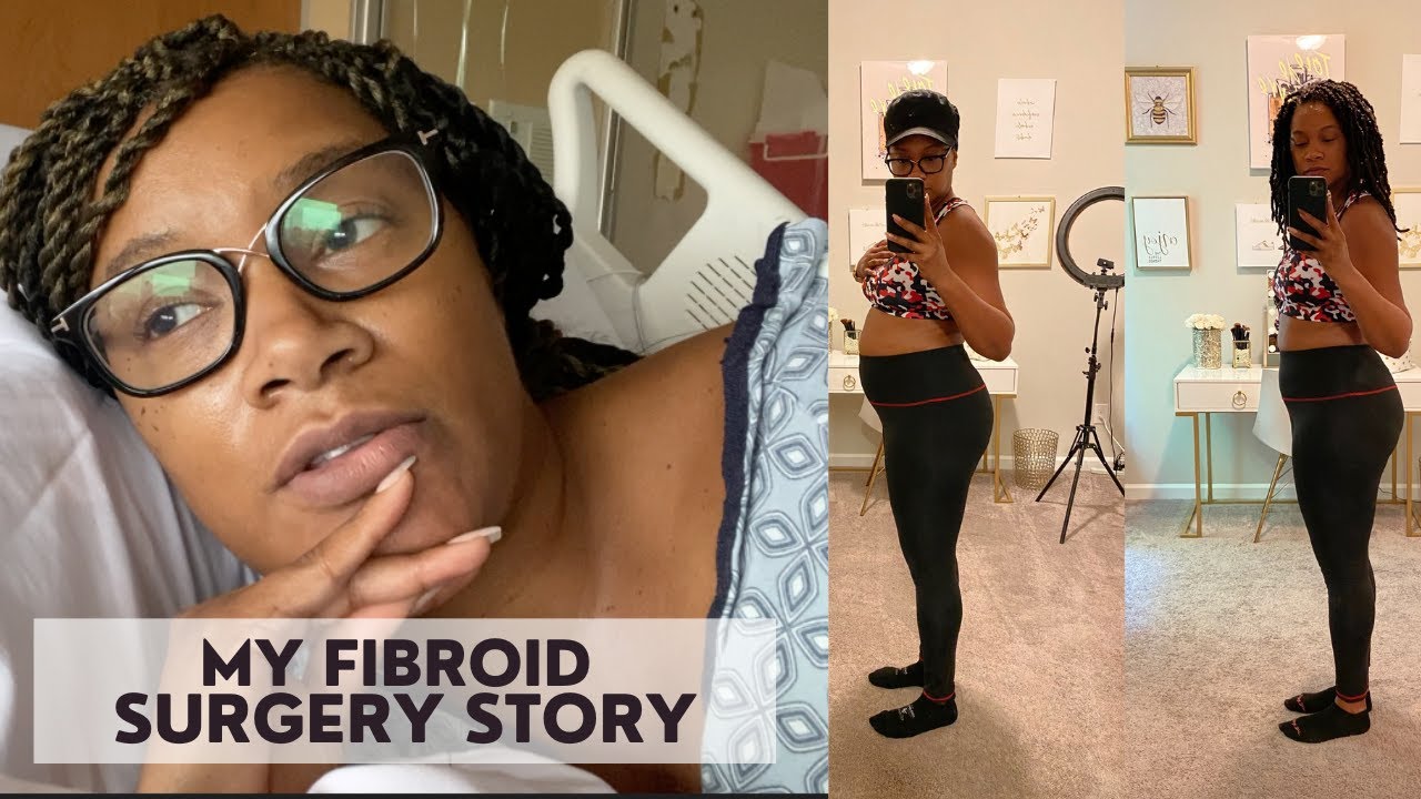 My Fibroid Story | 56 Fibroids Removed | 6 Week Surgery Recovery Vlog ...