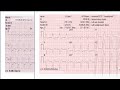 شرح تخطيط القلب ecg sgarbossa criteria