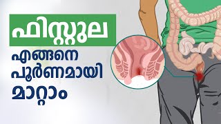ഫിസ്റ്റുല എങ്ങനെ പൂർണമായി മാറ്റാം | What is Fistula | Best Treatment for Anal Fistula