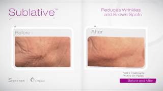 eMatrix Sublative Skin Rejuvenation Utah