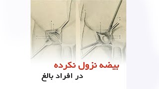 بیضه نزول نکرده در افراد بالغ _ دکتر سید امین میرصادقی