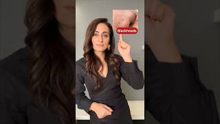 Blackheads, whiteheads, acne dark spots, open pores | dermatologist suggests