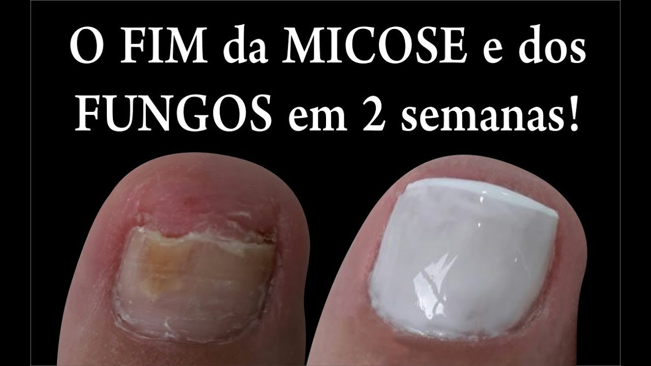 O FIM DAS MICOSES E FUNGOS NAS UNHAS EM 2 SEMANAS Feat. Kátia Rosenberg ...