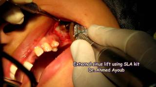 Sinus LIfting using SLA neobiotech kit