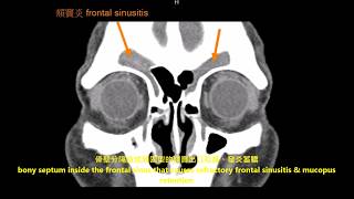 鼻竇內視鏡微創手術：困難型的額竇炎 骨壁分隔的氣室 difficult frontal sinusitis: FESS for intrafrontal sinus bony air cell