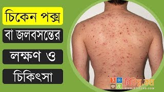 জলবসন্ত বা চিকেনপক্স হলে করনীয় এবং দাগ দূর করার উপায়