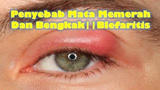 Penyebab Mata Memerah Dan Bengkak||Blefaritis