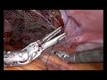 parastomal hernia robotic pauli repair