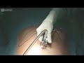 laparoscopic unroofing of simple liver cyst 2. trocar positioning