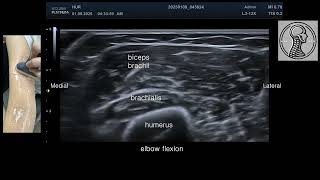 Ultrasound of the biceps brachii muscle. Courtesy of Dr. Mi-Sun Hur