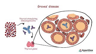 Graves disease - When your body produces too much Thyroid hormone