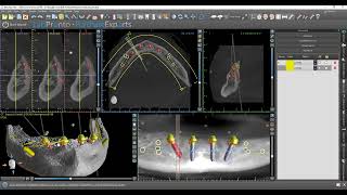 BIO | MultiOne Implants in Blue Sky Plan