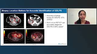 Integrating Personalized, Multidisciplinary Care in Dedifferentiated Liposarcoma