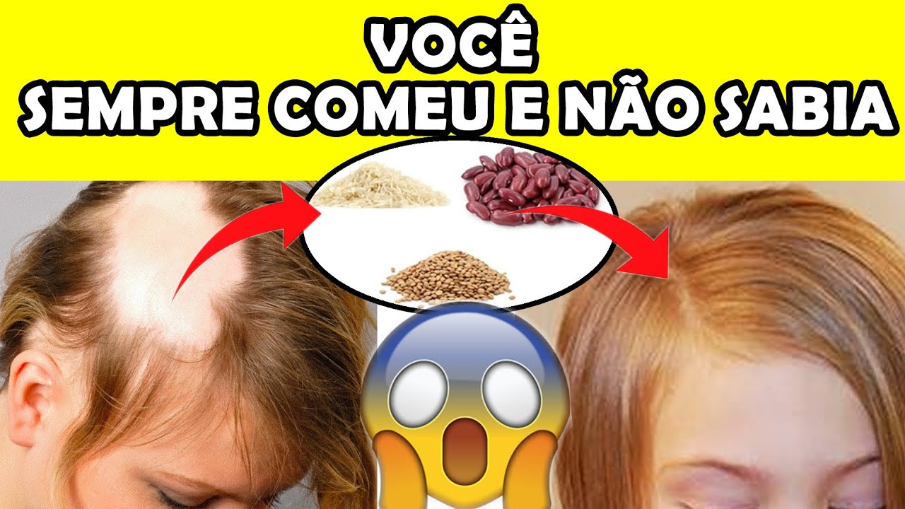 Queda De Cabelo - Alimentos Que Impedem A Queda De Cabelo, Tratamento ...