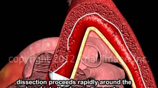 Aortic Dissection - Thoracic \u0026 Abdominal - Animation by Cal Shipley, M.D.