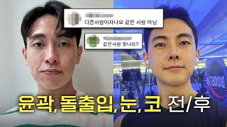 이게 가능해? 반응 폭발한 남자 성형 전후🔥ㅣ윤곽+돌출입+눈+코+리프팅ㅣ원진성형외과의원