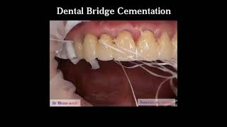 Dental bridge cementation