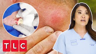 “It’s Like Mashed Potatoes” Dr Lee Removes 20 Year Old Cyst On Man’s Neck | Dr Pimple Popper Pop Ups