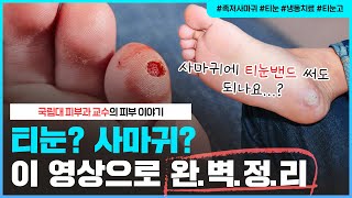 🦶🏻발바닥에 딱딱하게 올라온 이것, 티눈인가요? 사마귀인가요?｜족저사마귀에 🩹티눈밴드(티눈고)🩹 써도 되나요? - [언니네피부과]