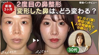 鼻の修正手術から3ヶ月が経ちました！術後の様子をお見せします②【30代女性の美容整形】リッツ美容外科