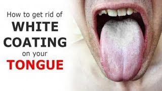 Remove Those White Patches On Your Tongue With These Amazing Natural Remedies!