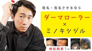 ダーマローラーの育毛効果がすごすぎた…💡ミノキシジルとの使い方を徹底解説！！