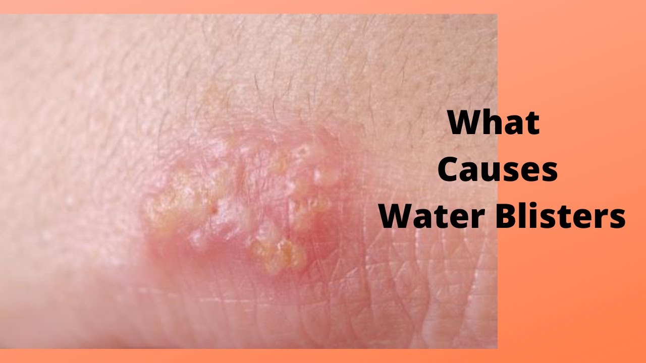 Why Do Blisters Itch