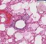 Histopathology Lung--Early pneumonia