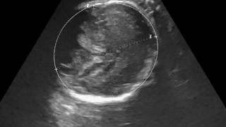 CASE 253 3D 4D FETAL dandy walker syndrome DWS