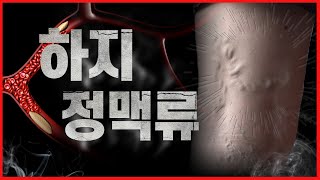 하지정맥류는 무엇이고. 만약 방치를 한다면... / 하지정맥류 통증과 증상