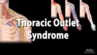 Thoracic Outlet Syndrome (TOS), Animation