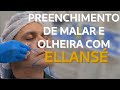 Dra. Carla Scanavini .Preenchimento de Malar e olheiras com Ellansé