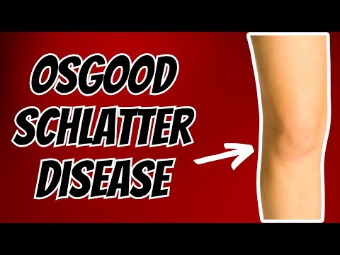 Top 3 Treatments for Osgood Schlatter Disease or Syndrome. Top 3 Treatments for Osgood Schlatter Disease or Syndrome.