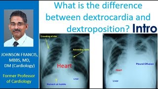 What is the difference between dextrocardia and dextroposition? Intro