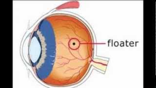 Best Cure For Eye Floaters - New  Way To Get Rid Of Eye Floaters - Treatment For Eye Floaters